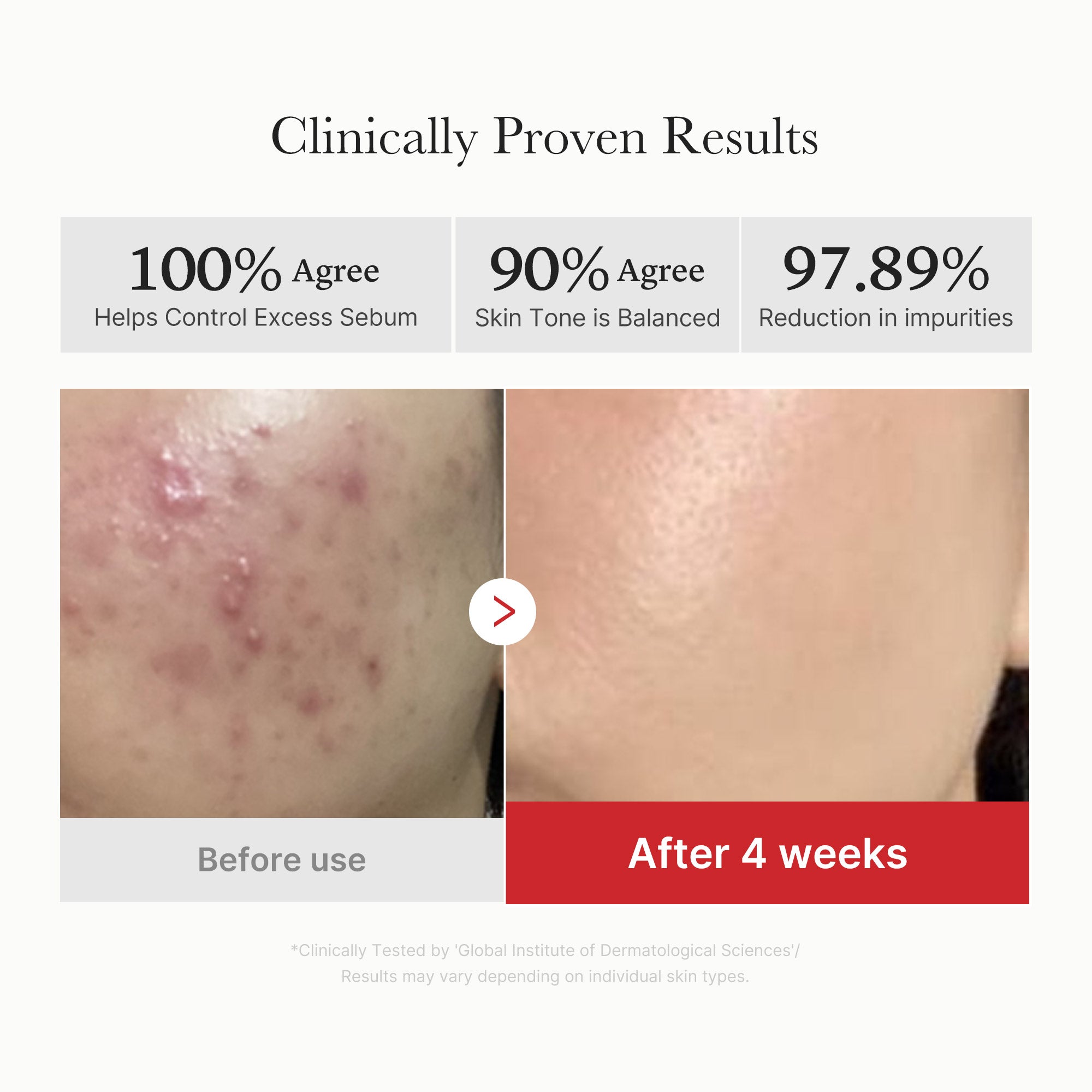 Red Line Acne Care Succinic Acid Panthenol pads in a white container with pads visible, designed for skin soothing and acne treatment.