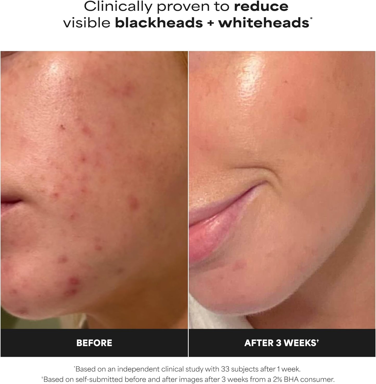 SKINZA Paula’s Choice Skin Perfecting 2% BHA Liquid Exfoliant bottle with white label and black cap on a plain background