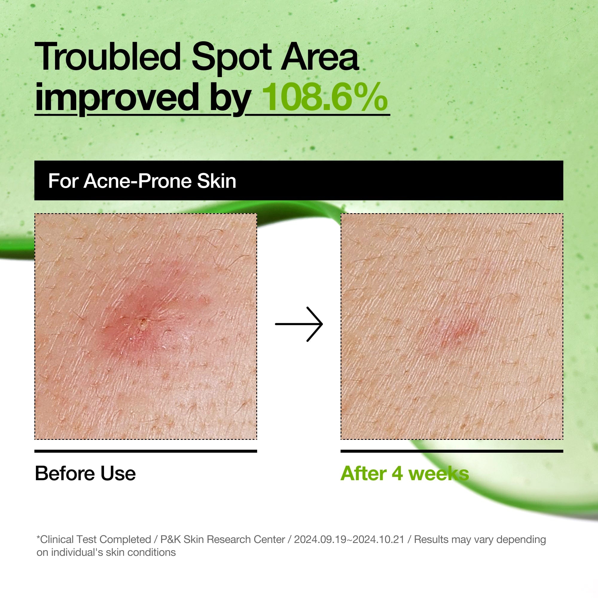 Anua Azelaic Acid 10 Hyaluron Redness Soothing Serum ampoule with clear liquid and dropper for skincare.